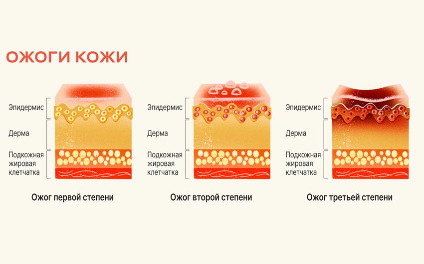 Классификация ожогов